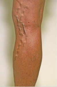 Лечение варикоза на ногах