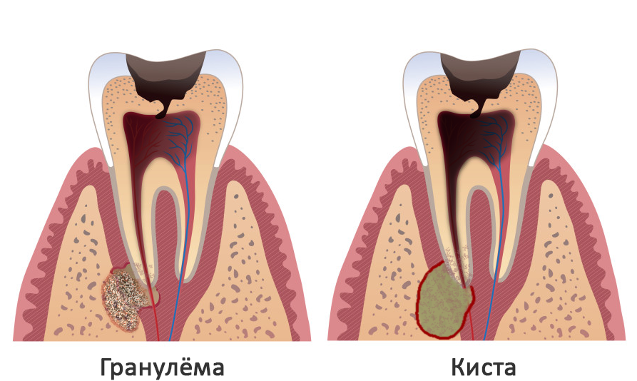 Гранулема зуба