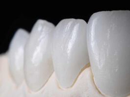 Керамические виниры: преимущества, этапы установки
