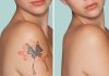 Unveiling the Best Tattoo Removal Methods: Erase the Past with Confidence