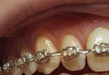Брекеты: путь к идеальной улыбке