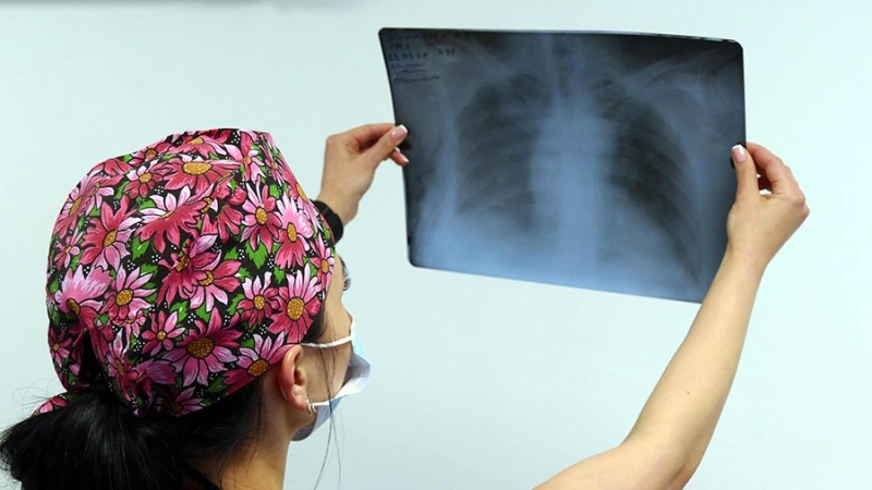 Показатель смертности от туберкулеза снизился в Подмосковье на 14%